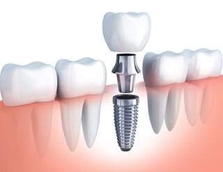 illustration of single dental implant being assembled to replace tooth in mouth, dentist Washington DC dental implants