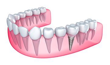 Chesapeake Dental Implants