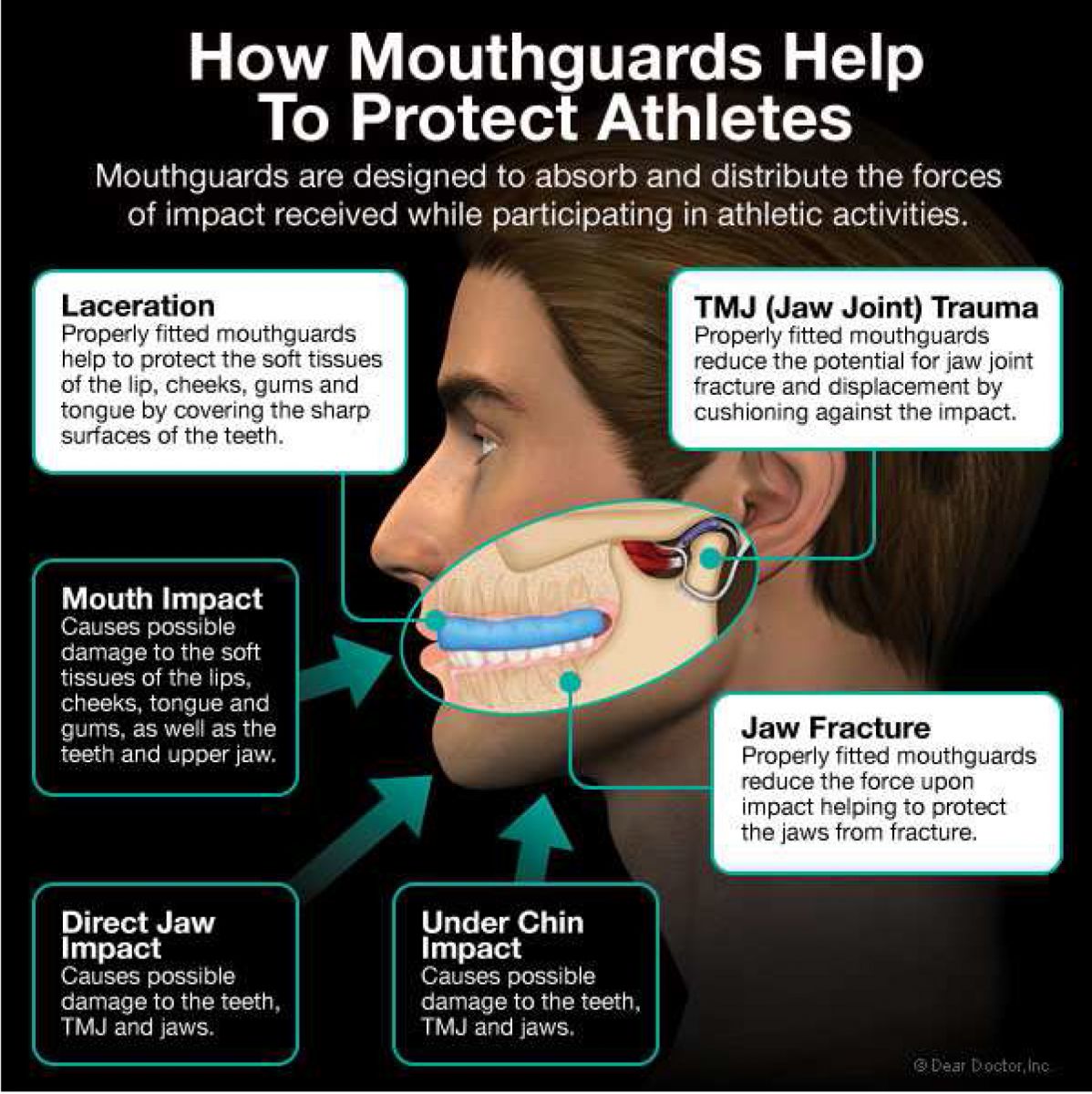 tips how mouthguards help to protect athletes