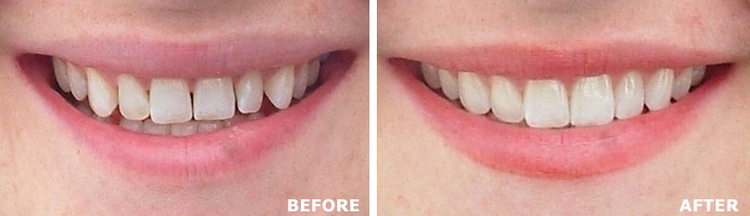 images of teeth before and after treatment with Invisalign in Arlington, TX