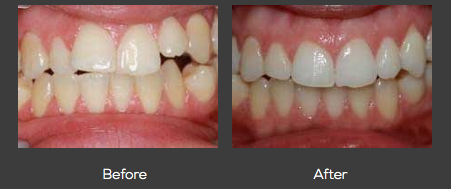 Before and After Cosmetic Dentistry