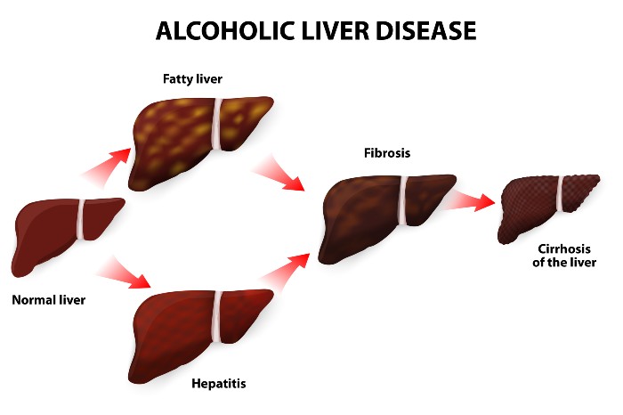 alcoholic_liver_disease