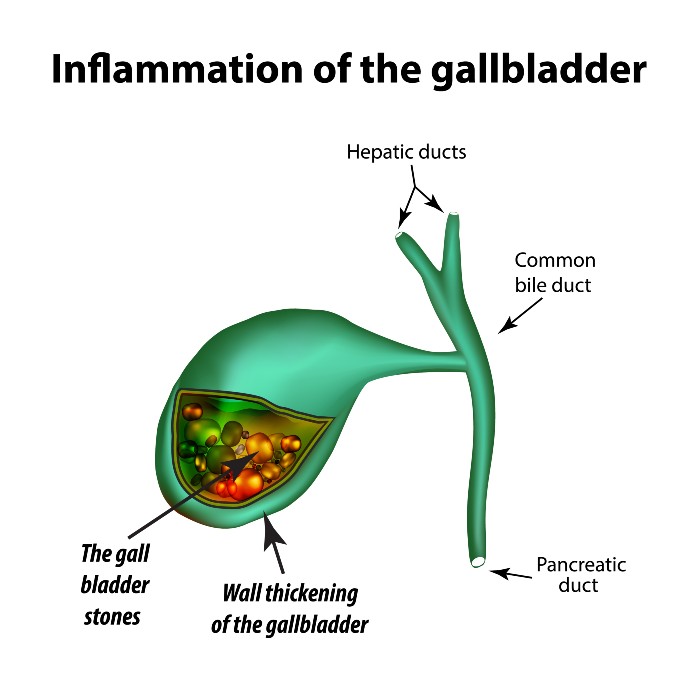 Gallbladder Disease - Gastroenterologist in Flemington & Hillsborough, NJ