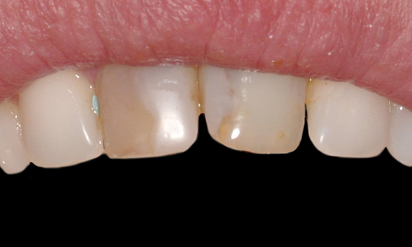 Smiling patient before cosmetic dentistry procedure