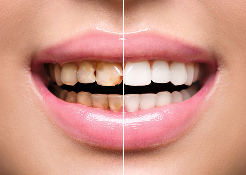 Cosmetic Dentistry in Foothill Ranch, CA  before and after
