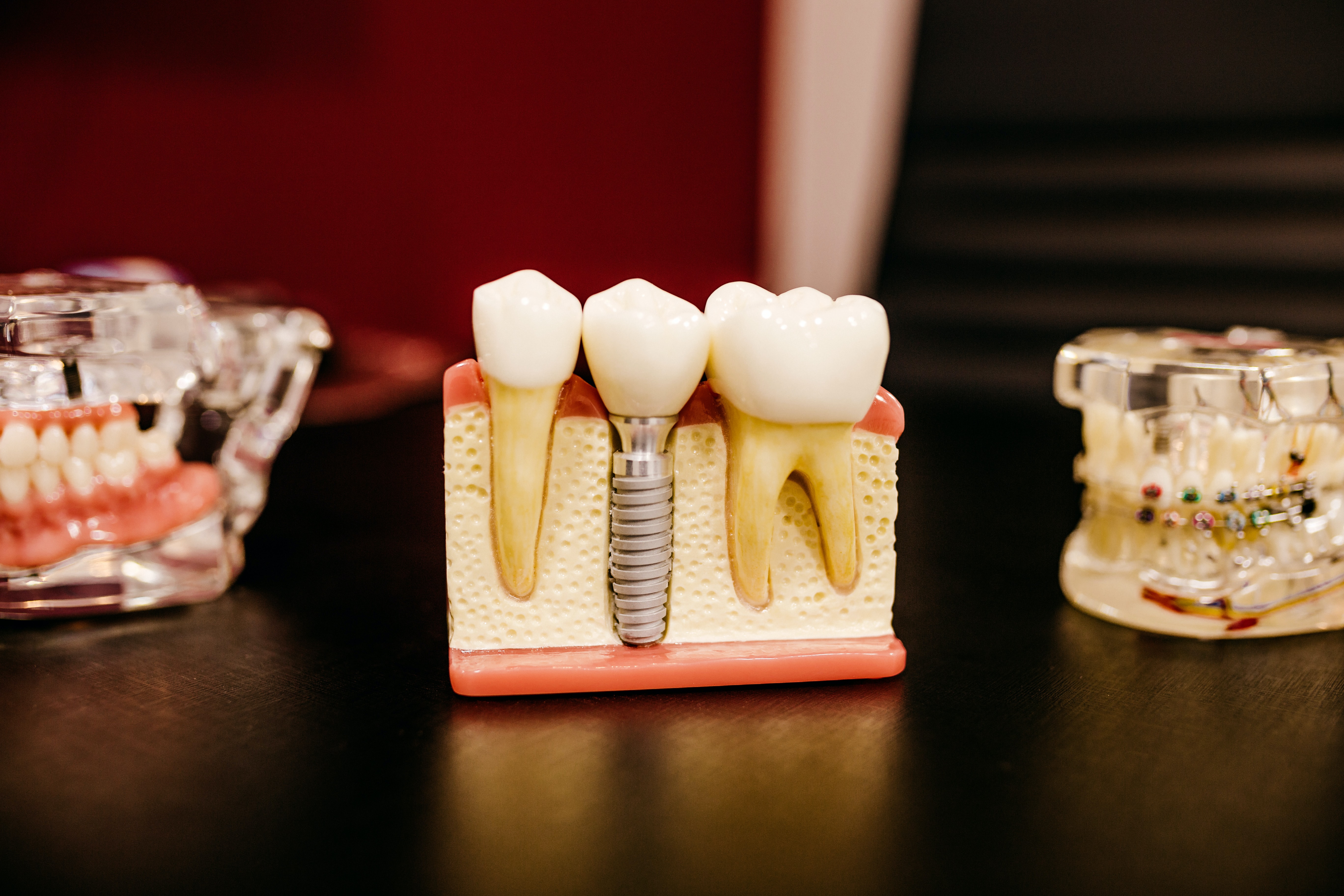 Photograph of Dental Implants jaw model in Harper Woods, MI and West Bloomfield, MI