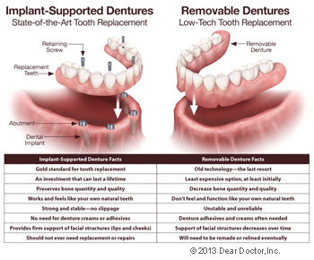 side by side comparison chart of implant supported dentures and removable dentures Manteca, CA & Stockton, CA 