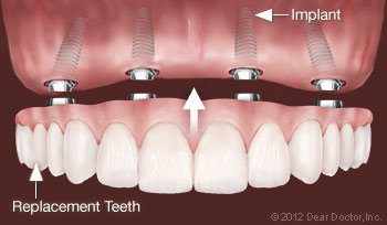 illustration showing implant supported dentures Manteca, CA dentist