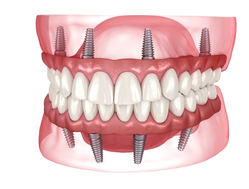 Dental Implants Manteca, CA