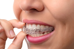 hand holding clear aligner in mouth, Invisalign Sioux Falls clear aligners
