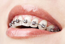 close up of woman's mouth, top row of teeth showing with metal braces Sioux Falls, SD orthodontist