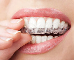 woman's hand placing clear aligners onto top row of teeth, clear aligners Sioux Falls, SD Invisalign treatment