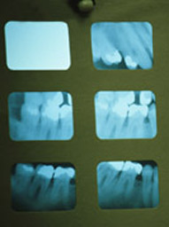 Dental Exam X-Ray