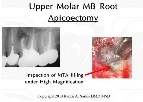 Microsurgical Apicoectomy Case 1