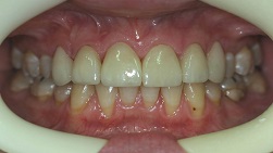 close up of woman's mouth showing teeth after new dental veneers Cumberland Park, SA dentist