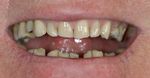 close up of man's teeth looking rough and uneven, dentist Adelaide SA