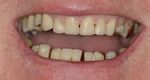 close up of man's teeth after cosmetic fillings Cumberland Park, SA dentist