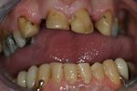 close up of man's mouth showing brown, worn, ugly teeth before smile makeover with dentist Adelaide SA