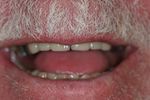 man's mouth smiling showing after results of cosmetic dentistry treatments from dentist Adelaide, SA