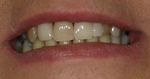 close up of woman's smile after getting new dentures Cumberland Park SA dentist