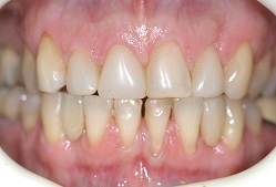 Porcelain Teeth and bonded dental bridge in mouth to replace gaps in smile, dentist Cumberland Park, SA