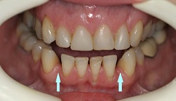 Cosmetic Makeover with Porcelain teeth and bonded dental bridge Cumberland Park dentist