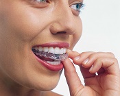 close up of woman smiling, placing clear aligner tray onto top row of teeth, Invisalign Cumberland Park, SA dentist
