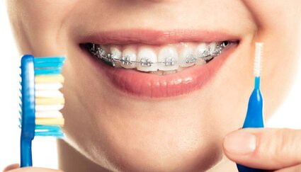 close up of woman's smiling mouth with braces, holding toothbrush near mouth, braces Decatur, IL orthodontics