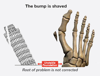 Traditional bunion surgery does not address the root problem