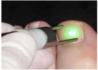 Fungal Nail Laser Treatment