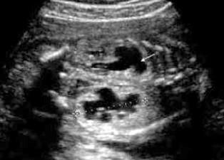 Prenatal photo 2