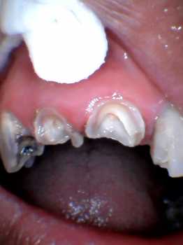 Before photo of two front teeth broken down to the gums