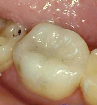 after photo of the tooth rebuilt with white filling material