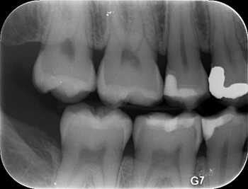 xray of teeth with decay