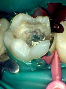 before photo of a very broken down tooth due to decay