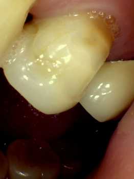 before photo of dark tooth root showing due to gum recession