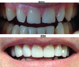 Veneers in Cape May County, NJ