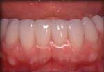 After Straightened Teeth Without Braces Testimonial