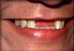 Before Partial Denture Smile (Testimonial)