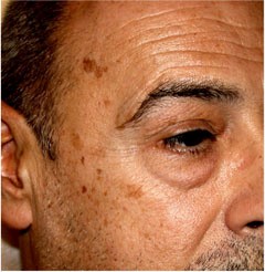 Brown Spots on Skin