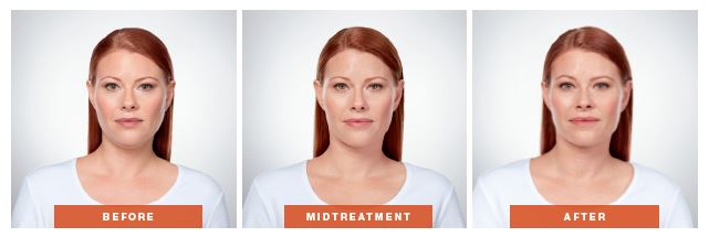 Front Facing Photos of Kybella Effects