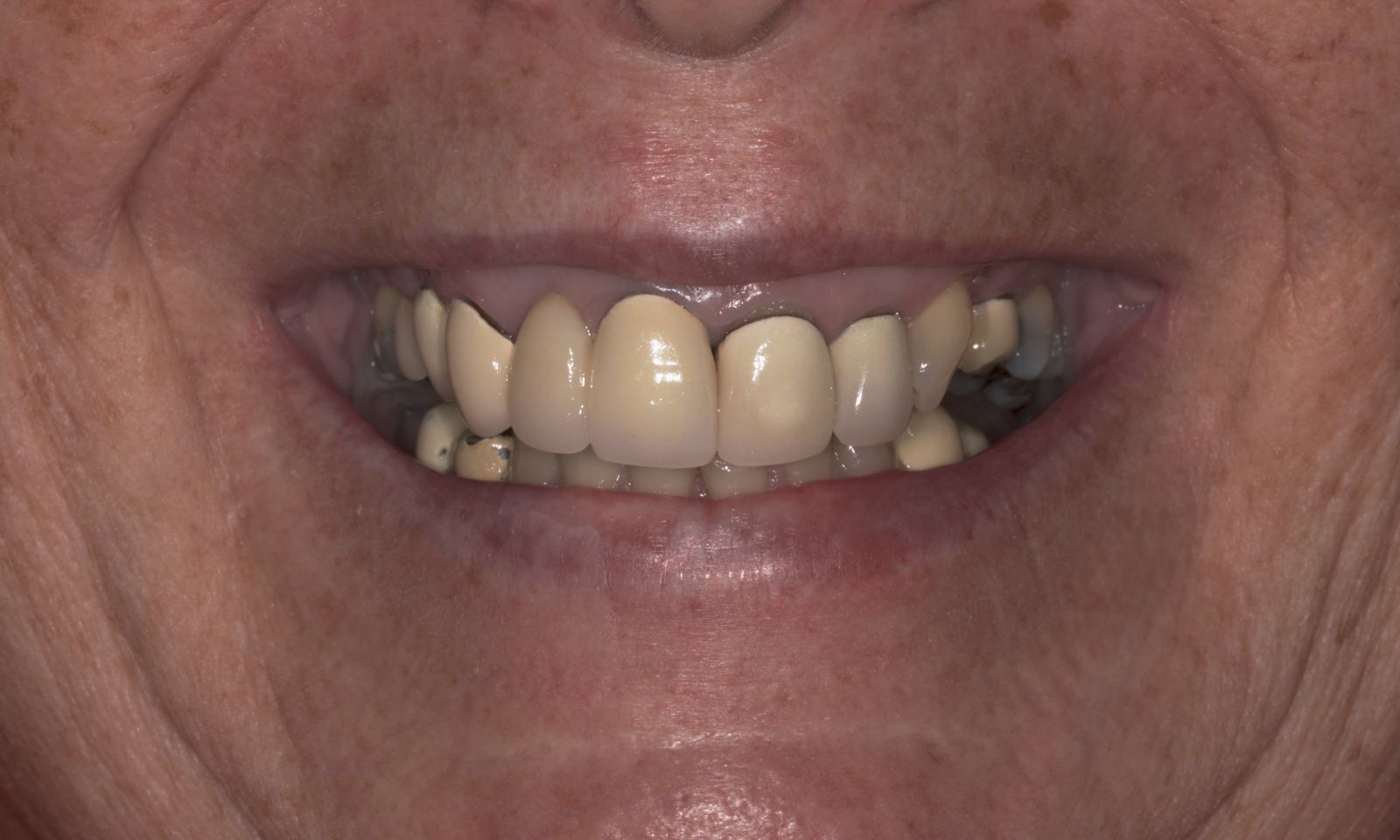 Full Mouth Rehab - Before