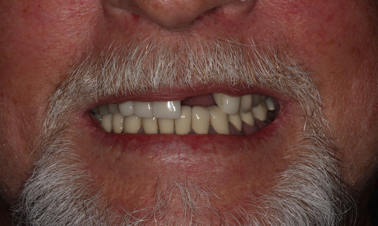 Dental Bridge Tooth Replacement - Before