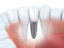 Glenview Dental Implant