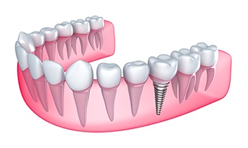 Illustration of a dental implant in a jaw in St. Louis, MO