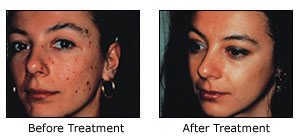 microdermabrasions before and after 2