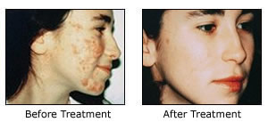 microdermabrasions before and after 3
