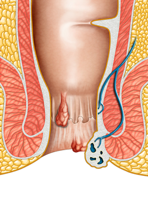 Hemorrhoids in Fair Lawn, NJ