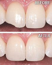 Teeth Bonding Westchester NY - Dentist
