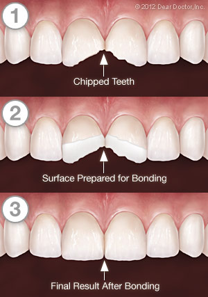Tooth Bonding - Step by Step. Scarsdale, NY